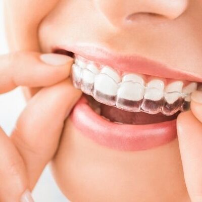 Tips for Covering Invisalign Costs